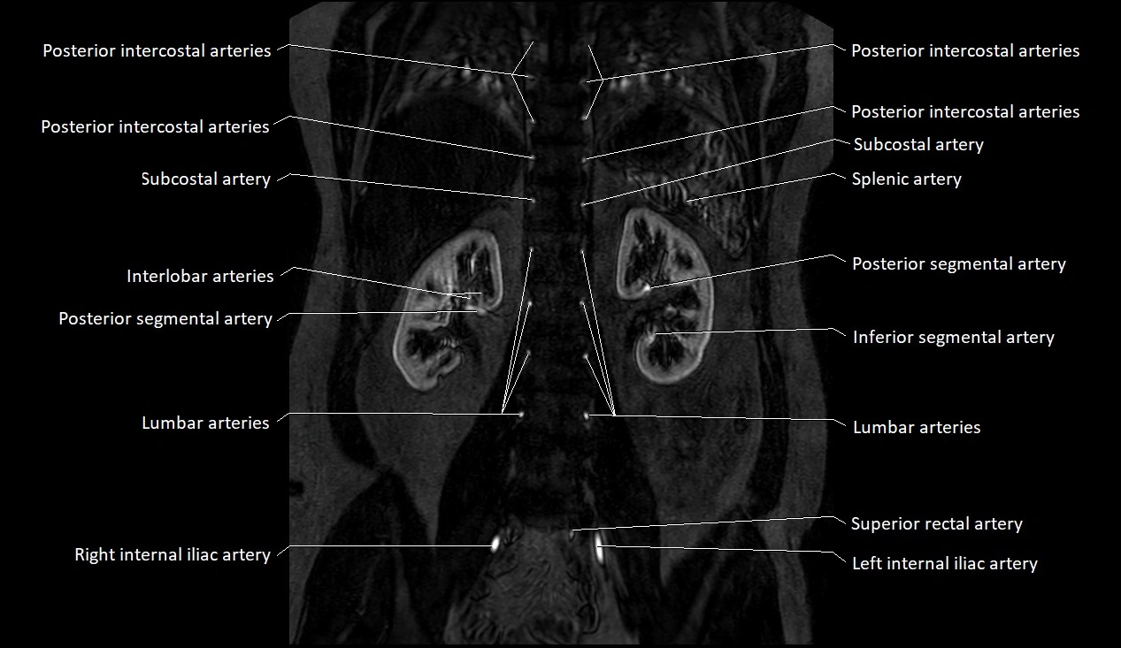 MRA Abdomen coronal anatomy image 36.webp